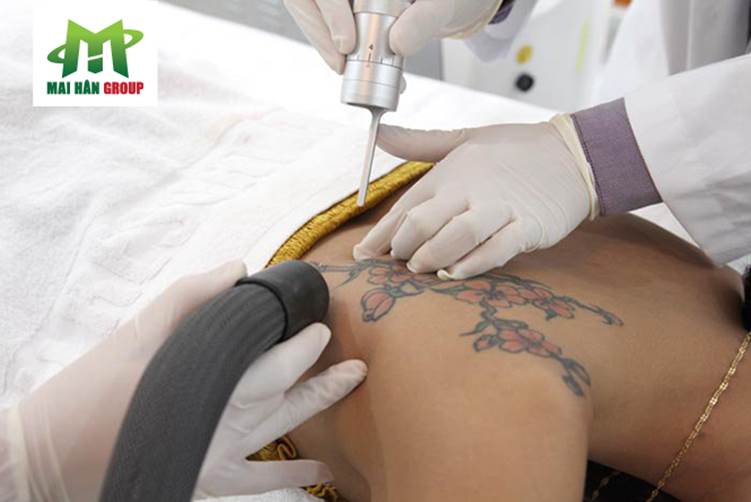 Quy trình xóa xăm laser hiện đại