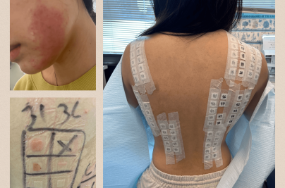 Tattoo Skin Patch Test: Do You Need One Before a Tattoo? skin20patch20test