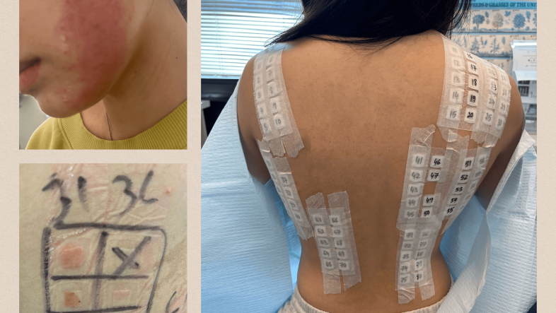 Tattoo Skin Patch Test: Do You Need One Before a Tattoo? skin20patch20test