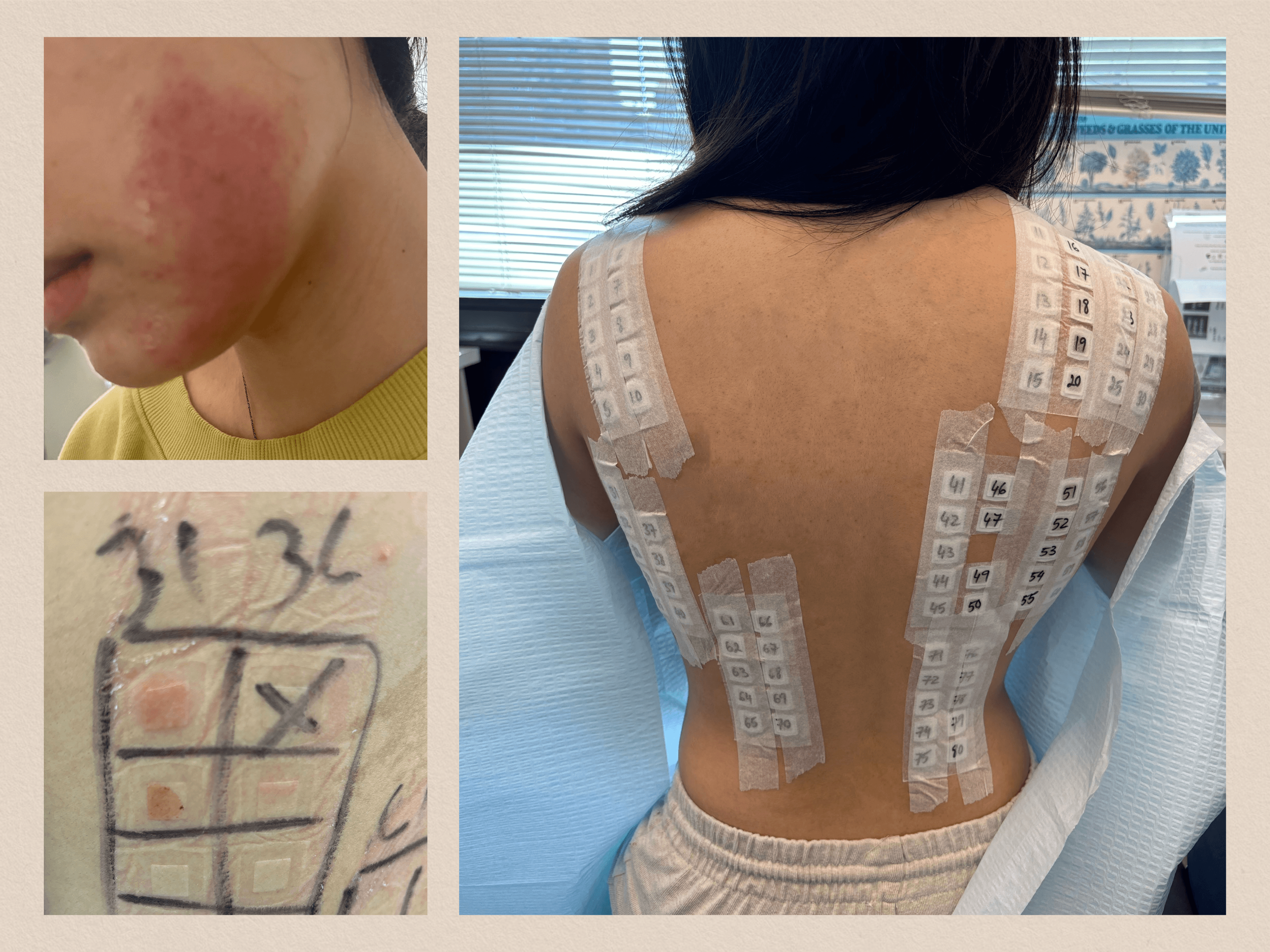 Tattoo Skin Patch Test: Do You Need One Before a Tattoo? 6 Tattoo skin patch test procedure for allergy screening before tattooing