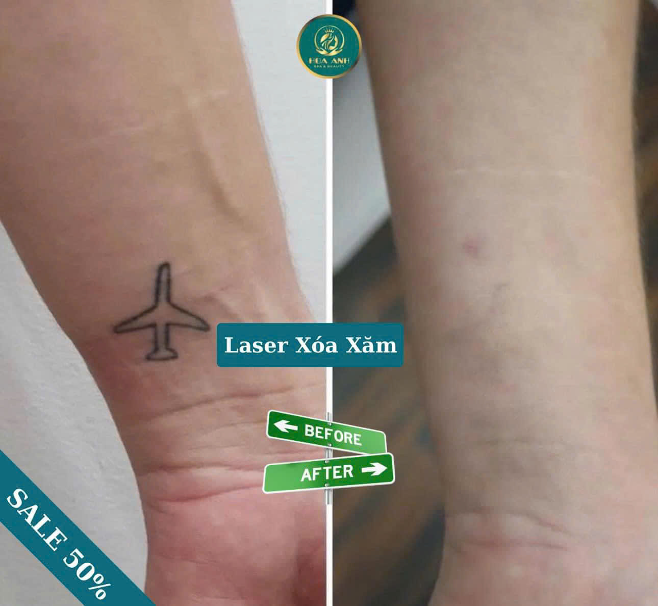 Các phương pháp xóa hình xăm hiện đại