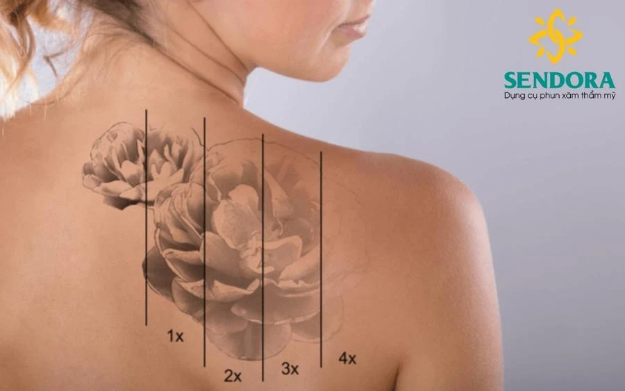 Xóa hình xăm bằng công nghệ laser hiện đại